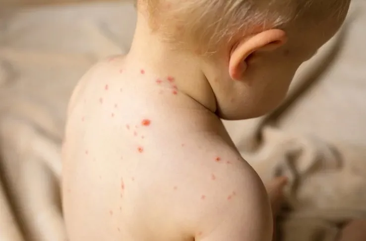 
                                                                                            What is Measles? Symptoms and Treatment
                                            
